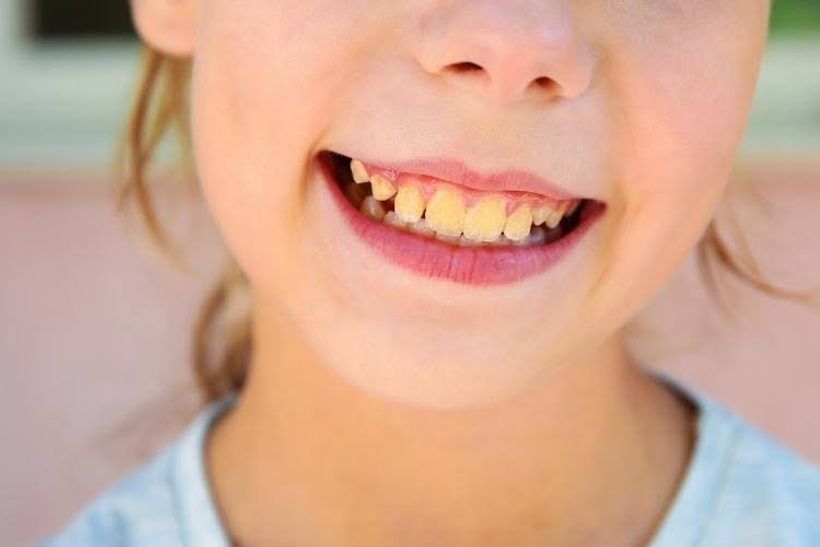 Close-up of a child's smile showing yellow discoloration on the teeth.