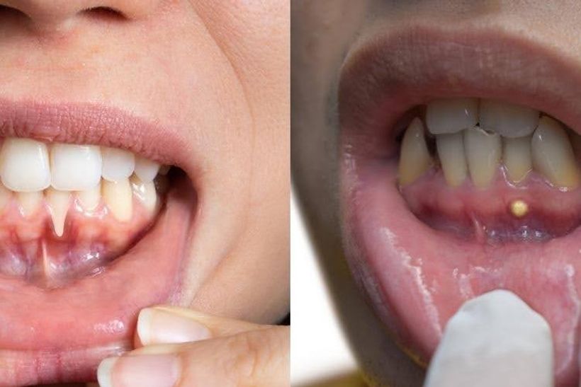 Comparison images showing gum inflammation and a possible dental abscess.