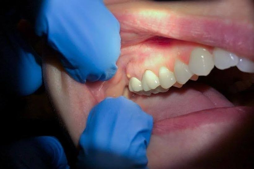 Close-up of a dentist examining a patient's gums and teeth.
