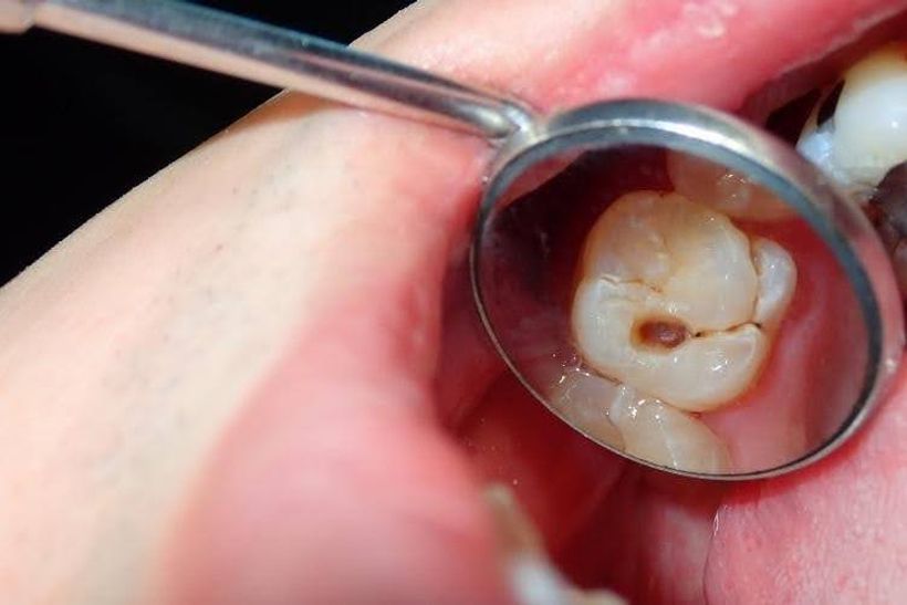 Dental mirror showing a visible cavity in a molar tooth.