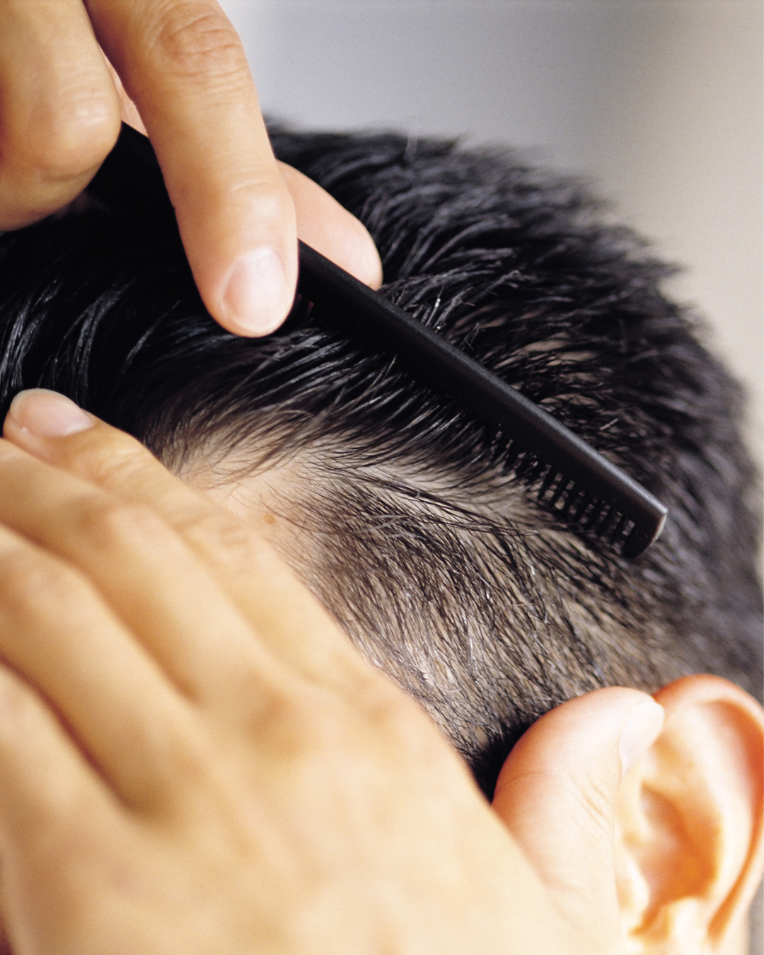 After 2 hair transplants, here’s what I learned: A story from Adham, Ouronyx Dubai’s Finance Director