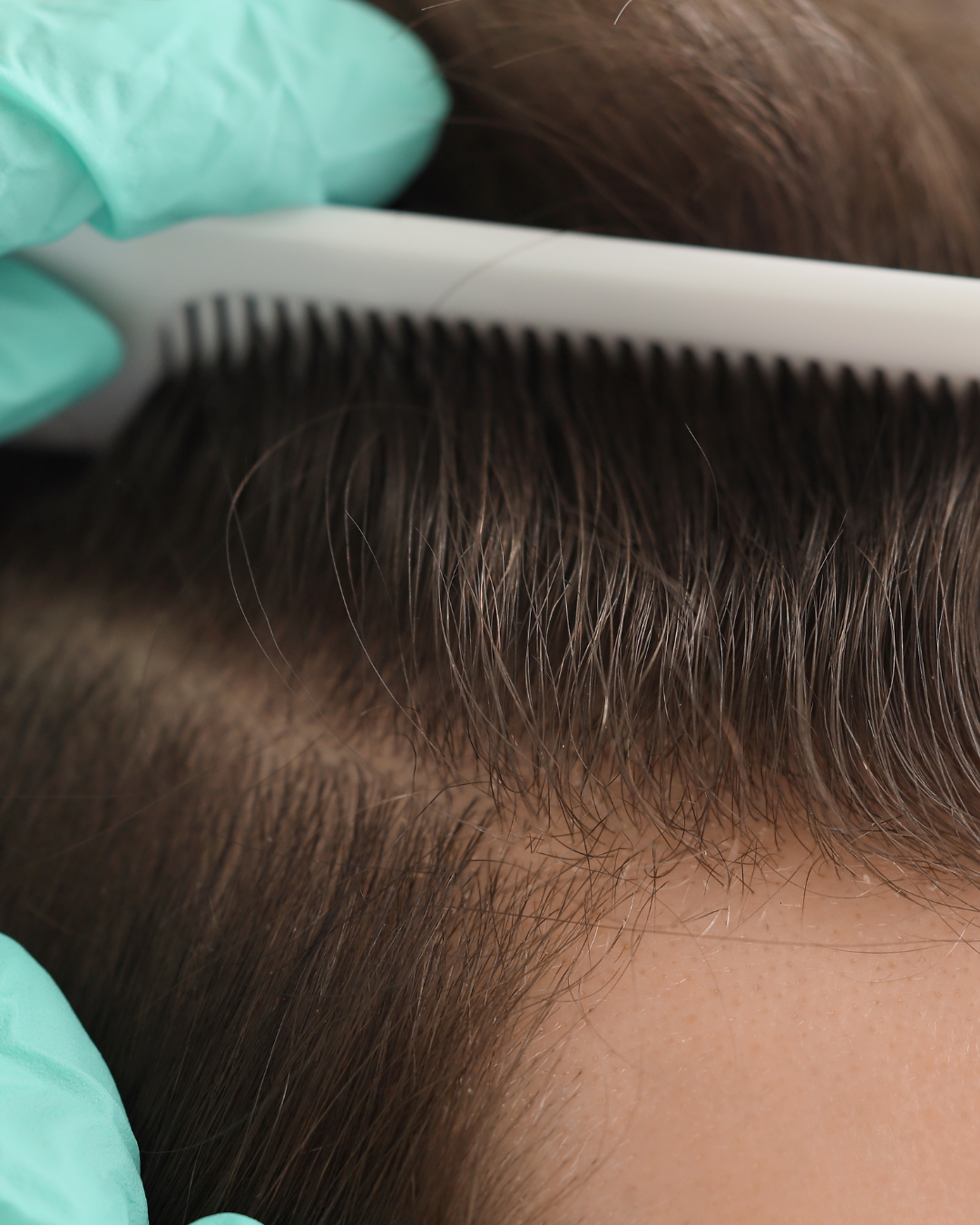 Hair transplants: the hair you keep matters more than the hair you replace