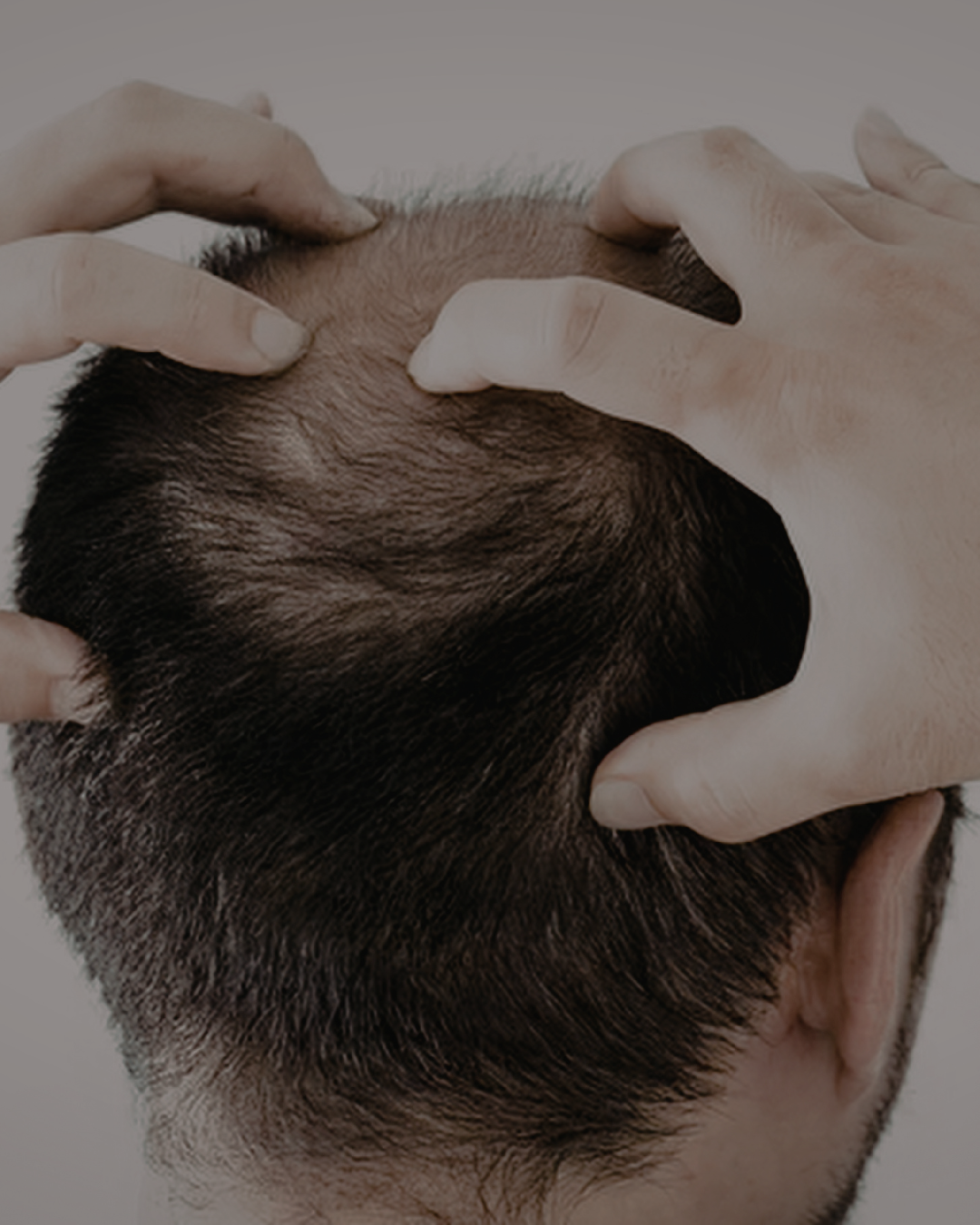 Why hair transplants are rarely ‘one and done’: the hair loss conversation no one is having