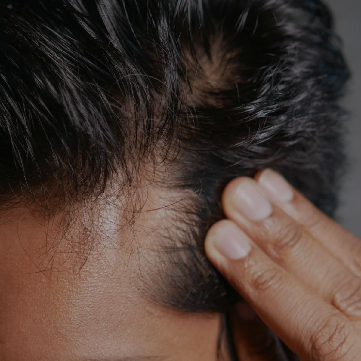 Hair Restoration