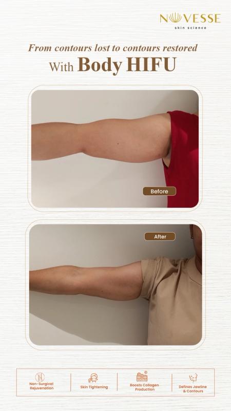 body-hifu