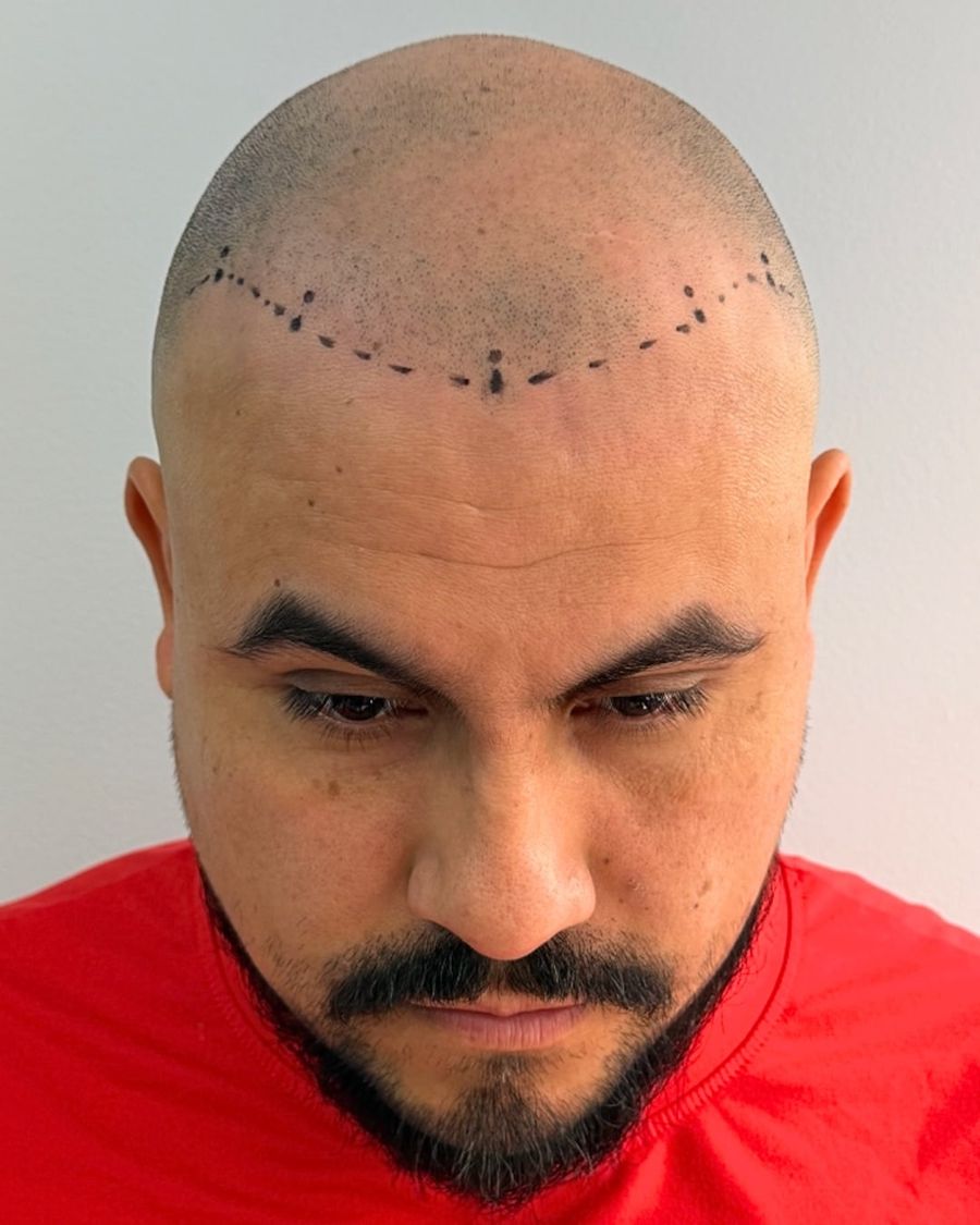 Before scalp micropigmentation: restore hairline