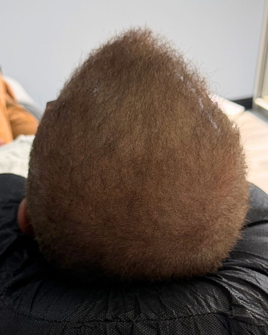 After scalp micropigmentation: density / thinning