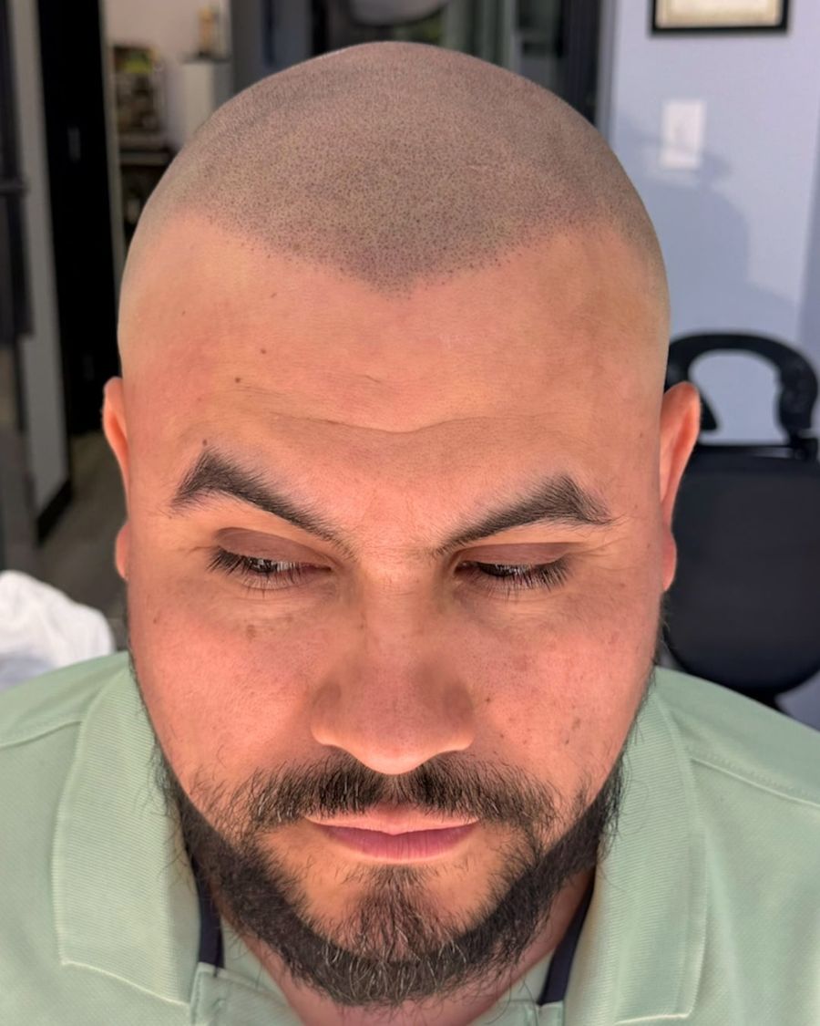 After scalp micropigmentation: restore hairline