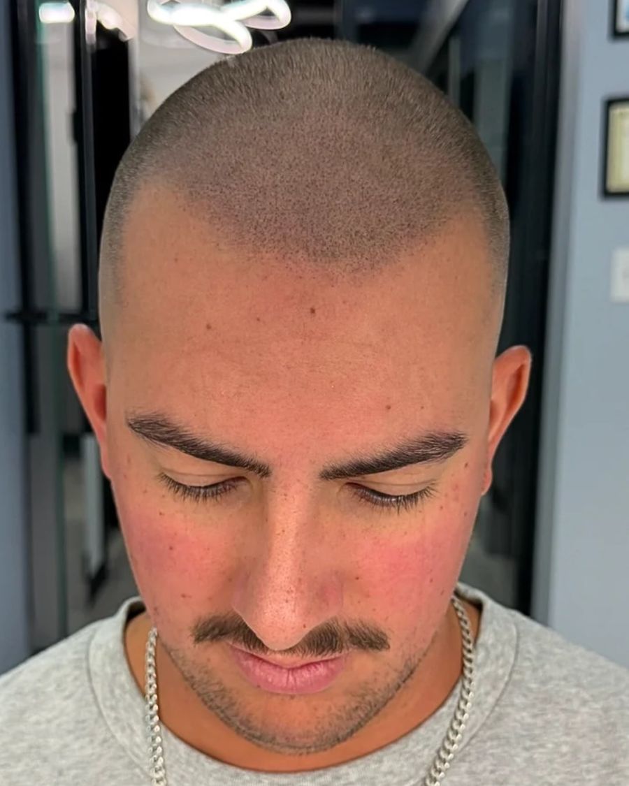 After scalp micropigmentation: restore hairline
