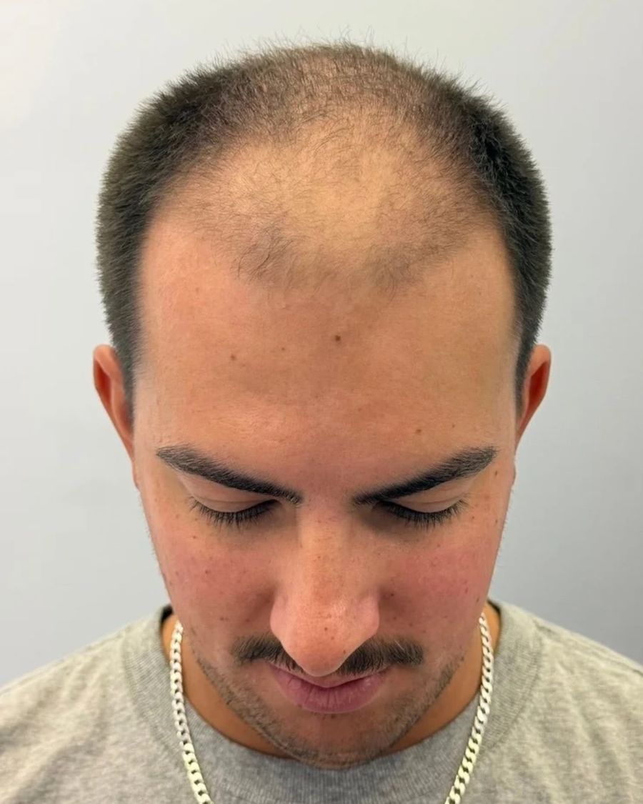 Before scalp micropigmentation: restore hairline