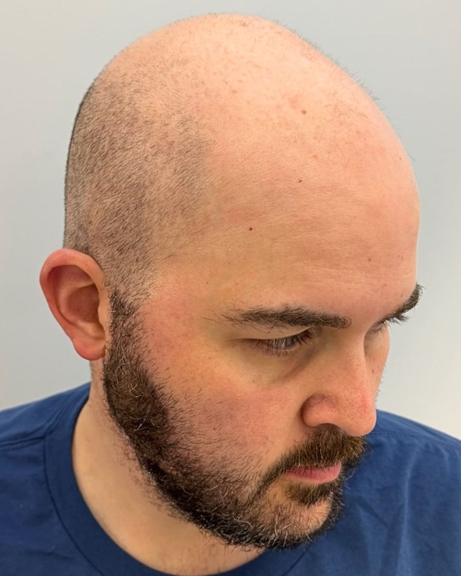 Before scalp micropigmentation: restore hairline