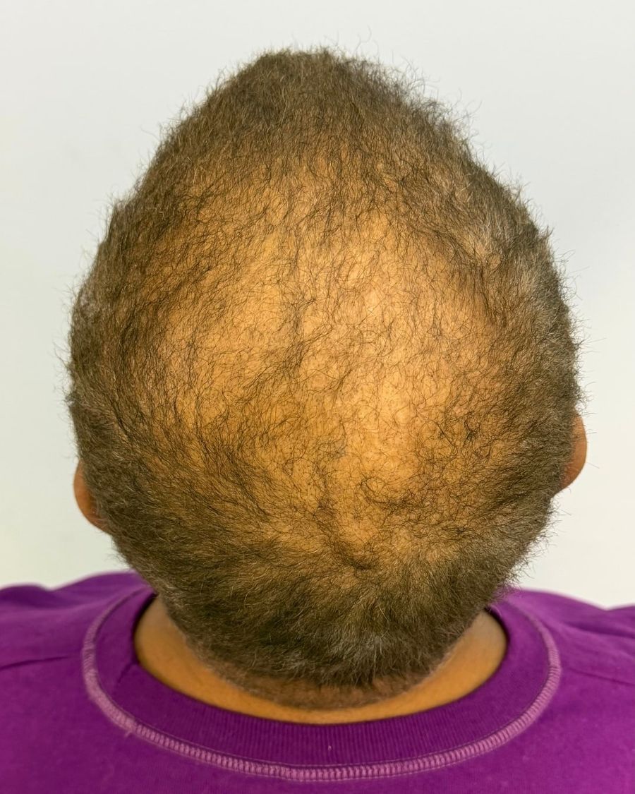 Before scalp micropigmentation: density / thinning