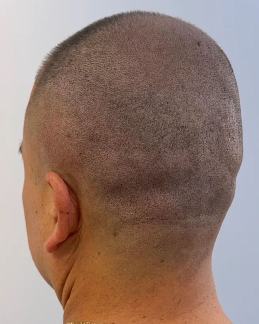 After scalp micropigmentation: scar camouflage