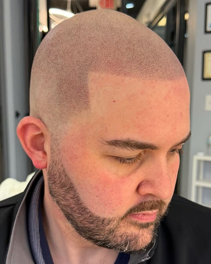 After scalp micropigmentation: restore hairline