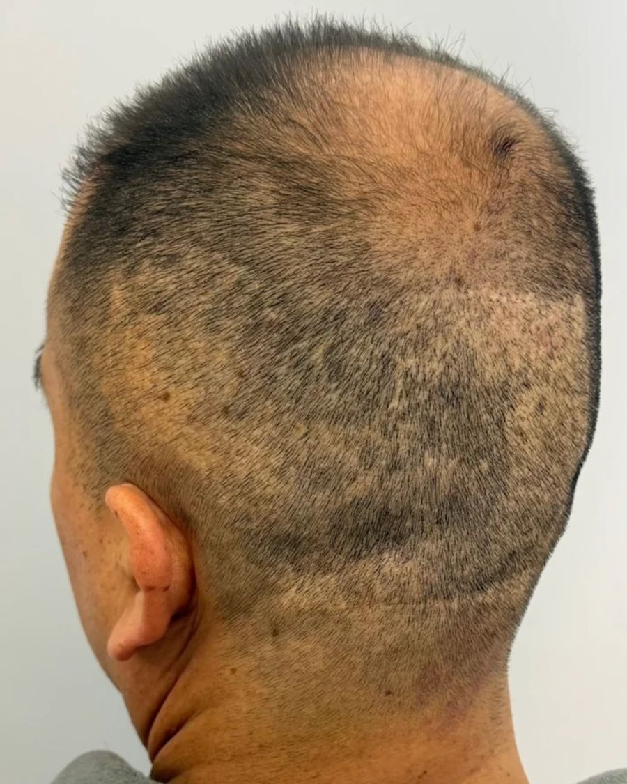 Before scalp micropigmentation: scar camouflage