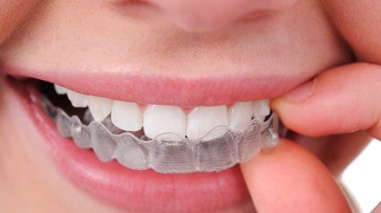 Ortodoncia Invisible