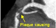 plaque causing severe blockage