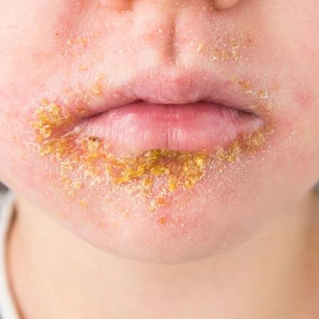 Impetigo