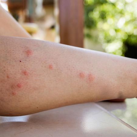 Infected Insect Bites
