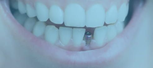 teeth with mini implant