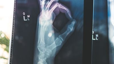 Cómo prepararse para una endoscopia digestiva