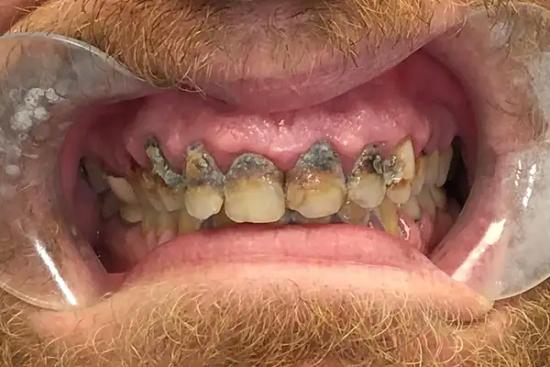 a close up of a man 's teeth with a beard .