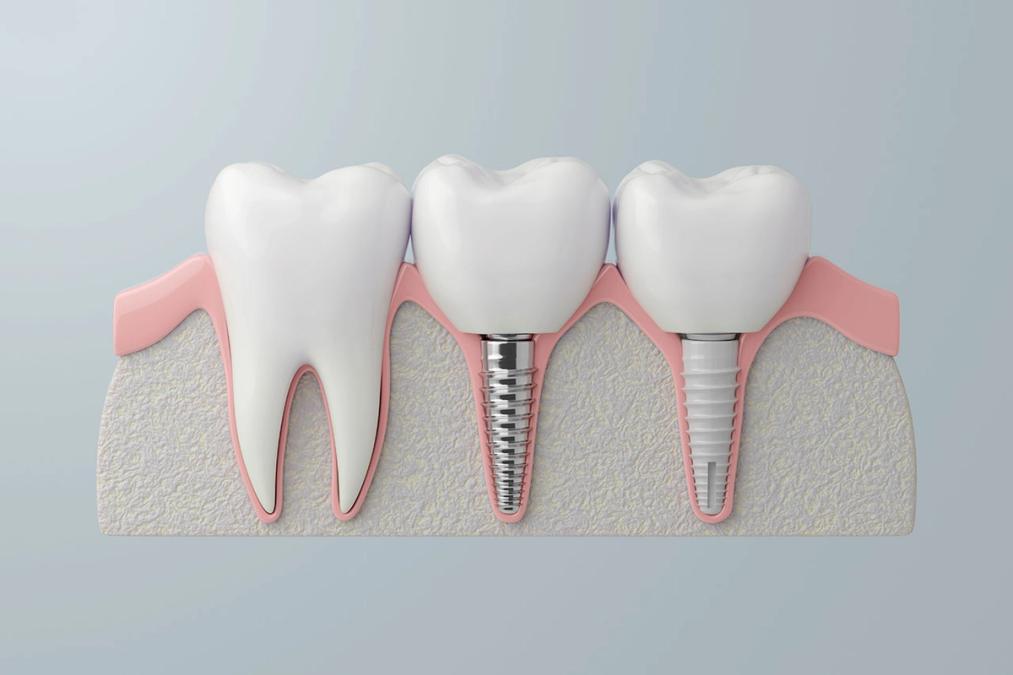 a 3d rendering of a tooth with a dental implant in it .
