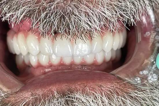 a close up of a man 's teeth with braces and a beard .