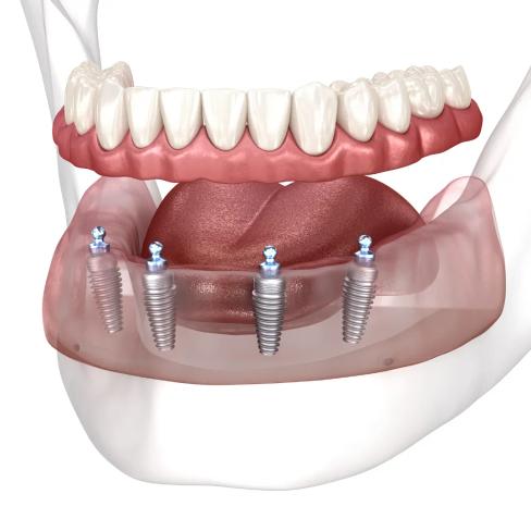 a computer generated image of a full denture with dental implants .