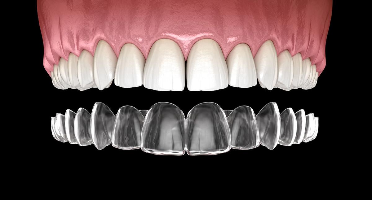 a close up of a person 's teeth with clear braces .