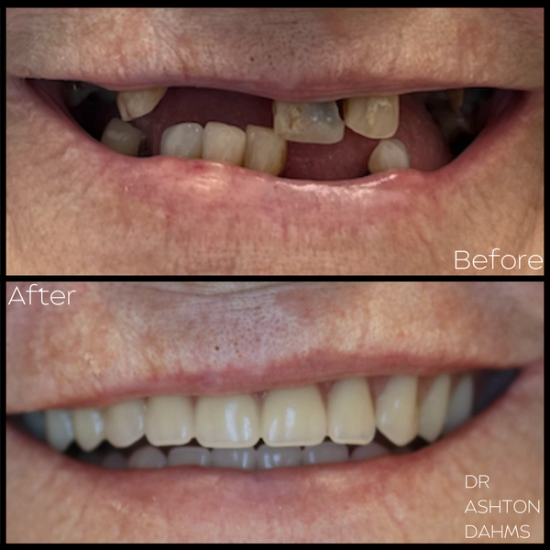 a before and after photo of a person 's teeth by dr ashton dahms