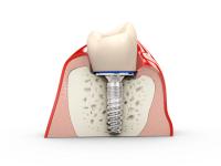 a 3d rendering of a dental implant in a tooth .