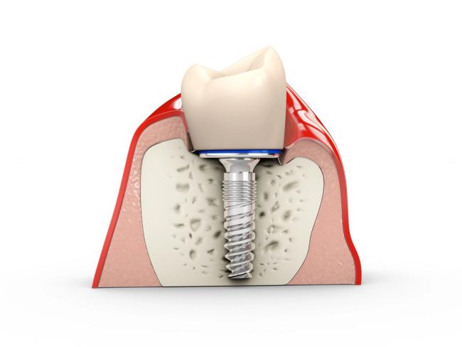 a 3d rendering of a dental implant in a tooth .