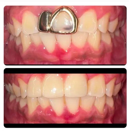 a before and after photo of a person 's teeth with a gold grill .