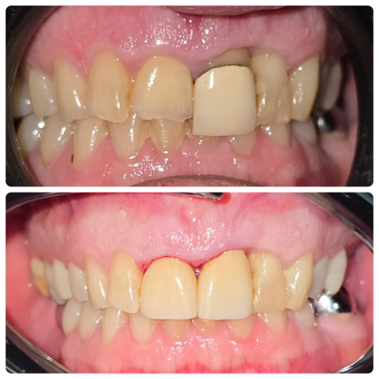a before and after photo of a person 's teeth