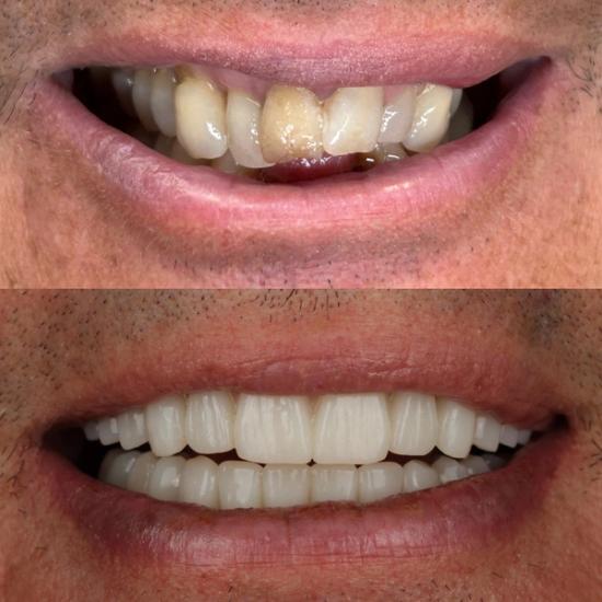a before and after photo of a man 's teeth .