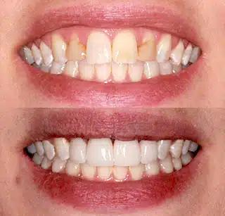 a before and after picture of a person 's teeth .