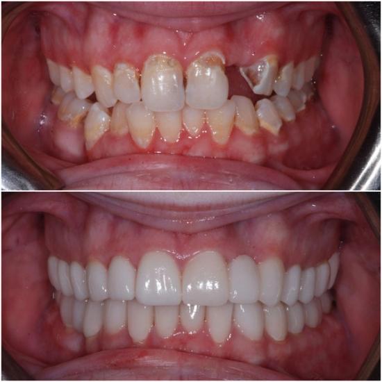 Before and after comparison of teeth, showing discolored and damaged teeth transformed into a full set of bright white, even teeth.