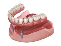 a 3d rendering of a full denture with dental implants .