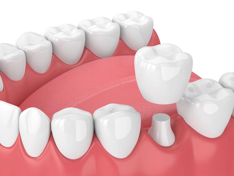 a 3d rendering of a dental crown being placed on a tooth