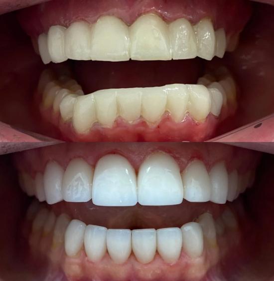 a before and after picture of a person 's teeth .