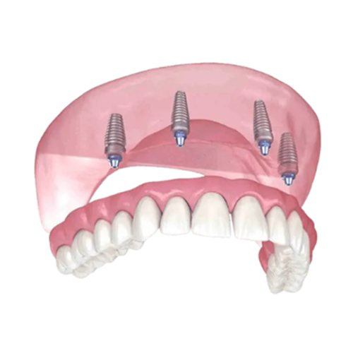 an illustration of a full denture with four dental implants