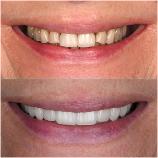 Before and after close-up of a smile, showing dental work transforming gapped, discolored teeth into straight, white ones.
