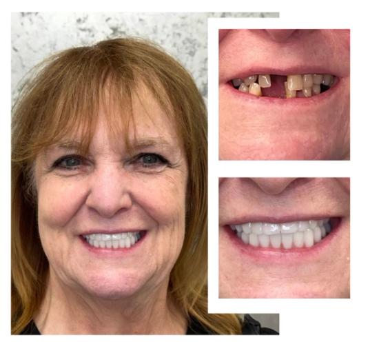 a woman with missing teeth and a smile before and after dental treatment .