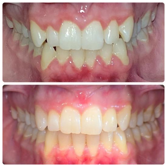 a before and after picture of a person 's teeth