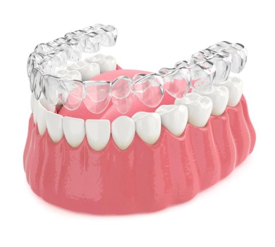 a 3d rendering of a mouth with invisalign braces on it .