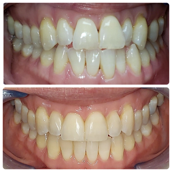 a before and after photo of a person 's teeth