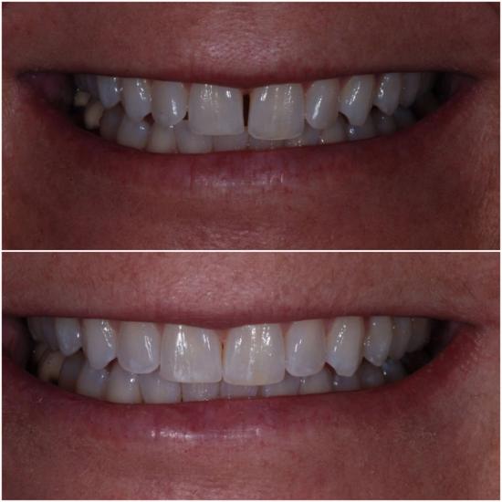 Before and after image showing a smile with a gap between the front teeth closed.
