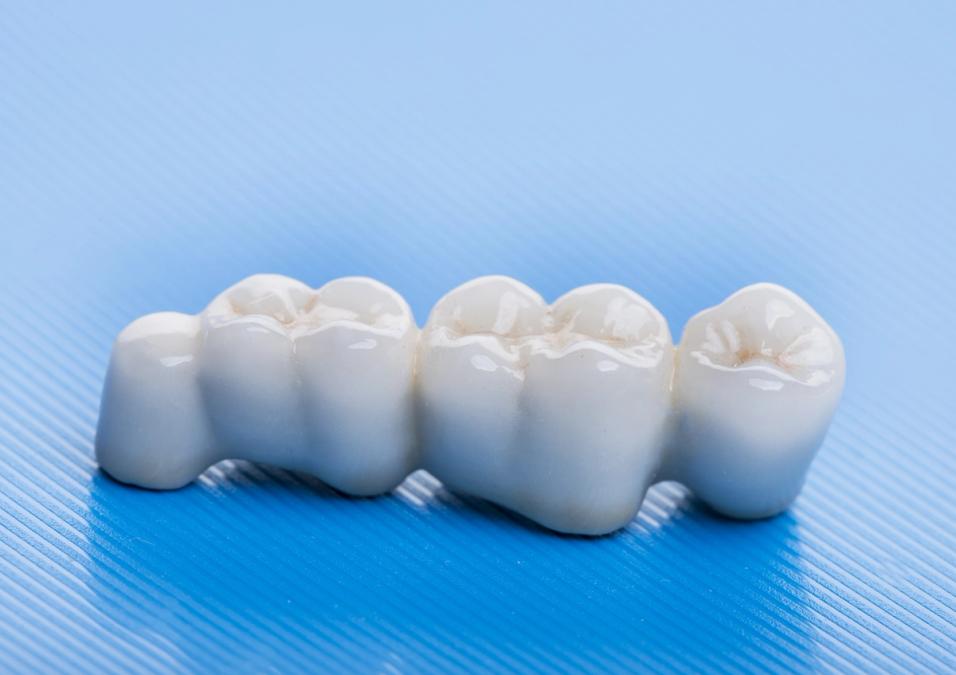 A white ceramic dental bridge with several crowns on a blue, textured background.