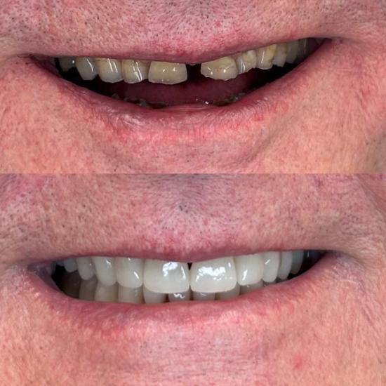 a before and after picture of a man 's teeth .